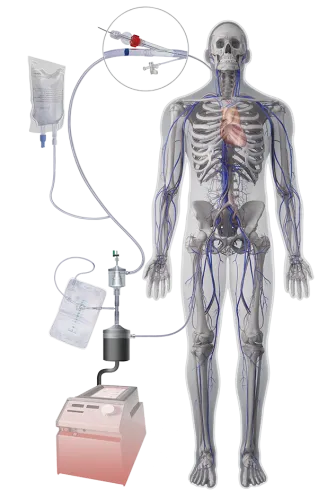 Mechaniczna apsiracja skrzeplin System AngioVac®