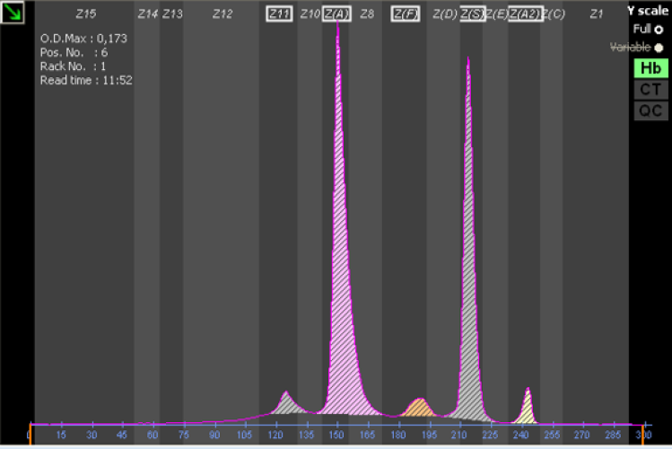Elektroforeza kapilarna Warianty Hemoglobiny