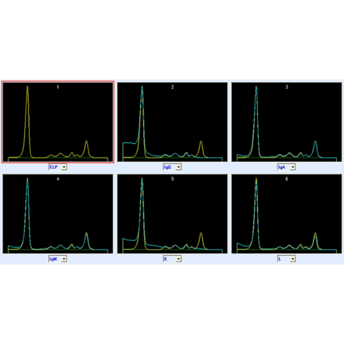 Immunotypowanie białek surowicy i moczu (IT)