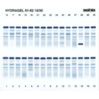 Elektroforeza białek surowicy i moczu (SPE, UPE)