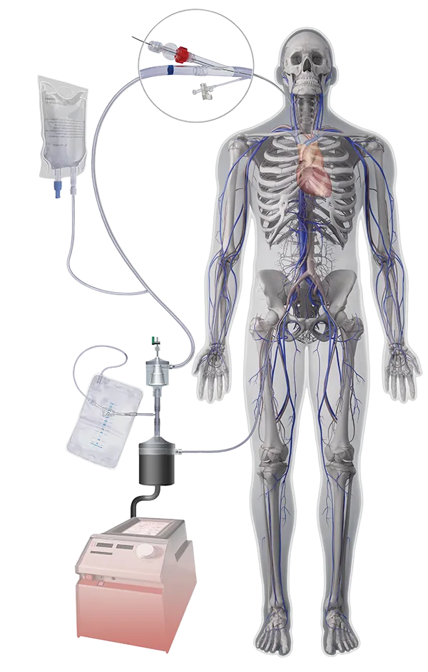 Mechaniczna apsiracja skrzeplin System AngioVac®