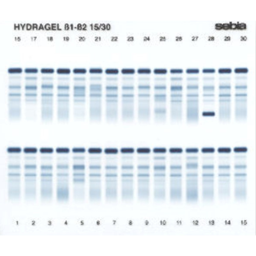 Elektroforeza białek surowicy i moczu (SPE, UPE)